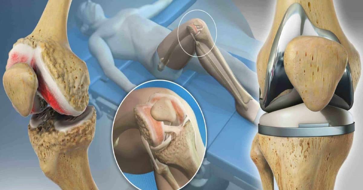 Quanto custa uma cirurgia de artrose no joelho?