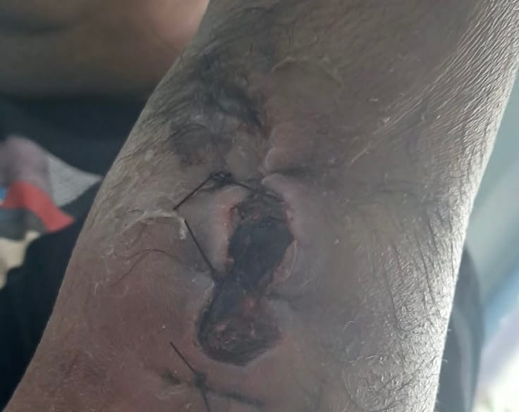 ABSURDO NA SAÚDE: homem esfaqueado em ataque que matou duas mulheres recebe alta com braço infeccionado e sangrando, em Poconé denuncia família