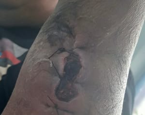 ABSURDO NA SAÚDE: homem esfaqueado em ataque que matou duas mulheres recebe alta com braço infeccionado e sangrando, em Poconé denuncia família